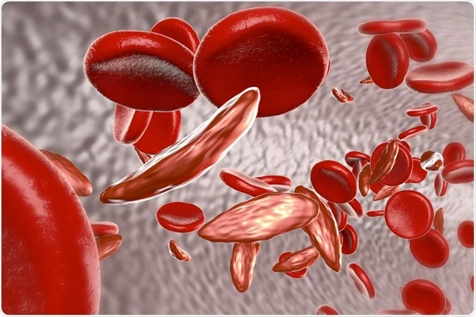 New Study Reveals Urgent Need For Nigeria to Institute National Legal Framework on Sickle Cell Disease