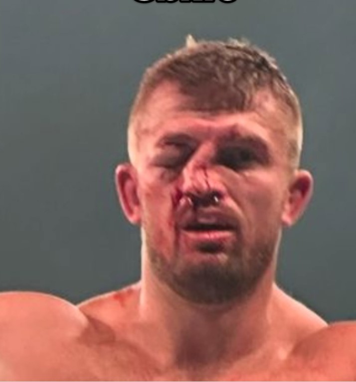 His nose and eye were badly injured and the bout was halted after two rounds