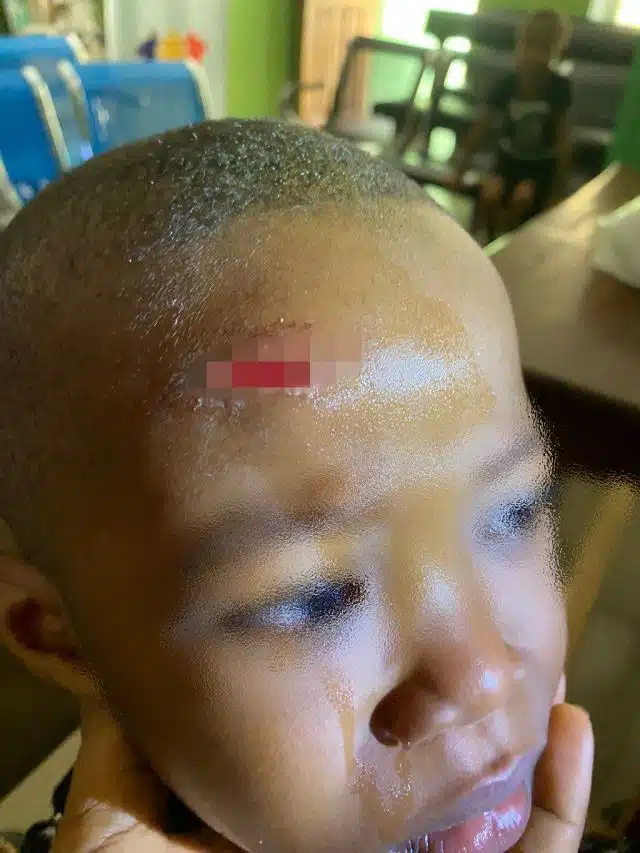 Mother raises alarm over scar on son caused by another student at school